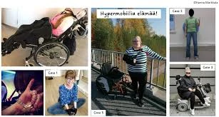Amputointi Ja Traumaperäinen Stressihäiriö