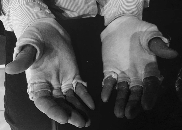 Erityiset Tilanteet, Joissa Kynsi Irtoaa