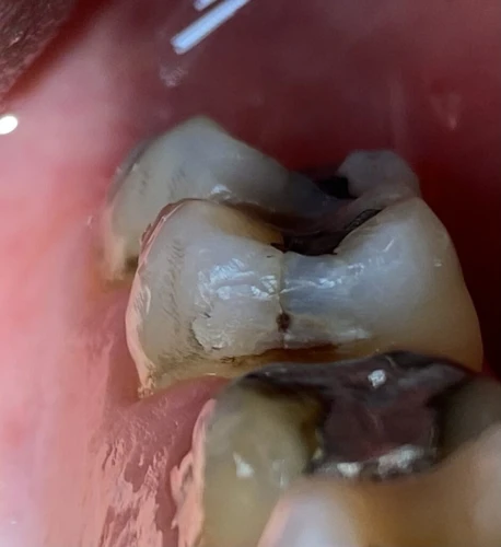 Hammas Lohkeamisen Jälkeiset Tuntemukset